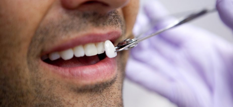 Dental Veneers​ cost in delhi, dr priyanka khanna's dental care 4u