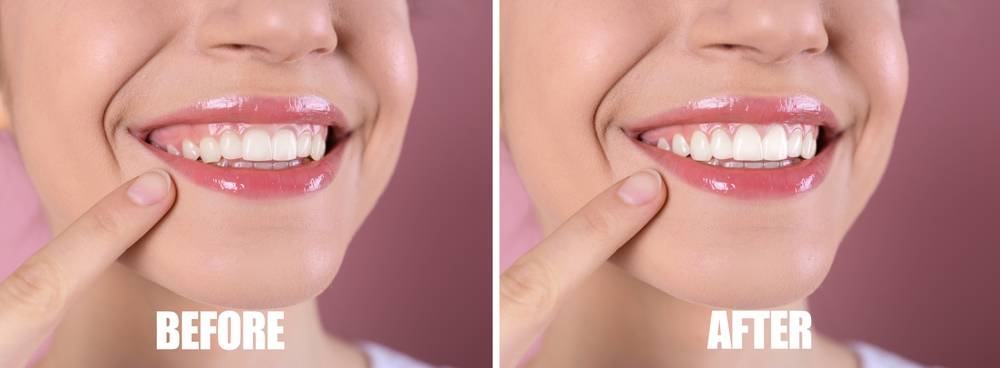 Gum Contouring​ need delhi, dental care 4u