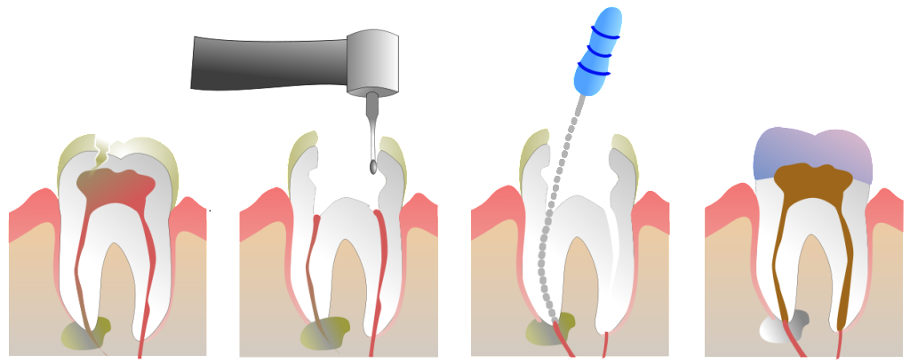 RCT Diagram, Cheap RCT in lajpat nagar delhi, painless RCT dr Priyanka khanna