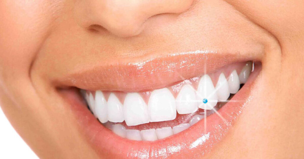 Tooth Jewelry ​cost in delhi, dental care 4 u