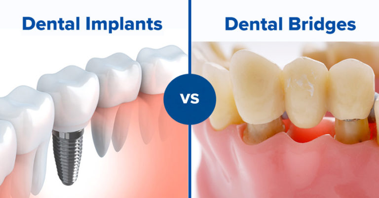 dental implant vs dental bridges, dental care 4u