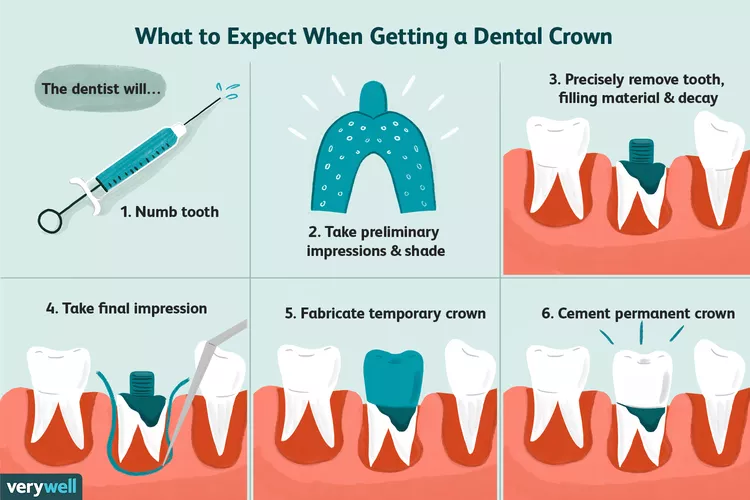 dental crown cost type procedure, dental crown lajpat nagar delhi