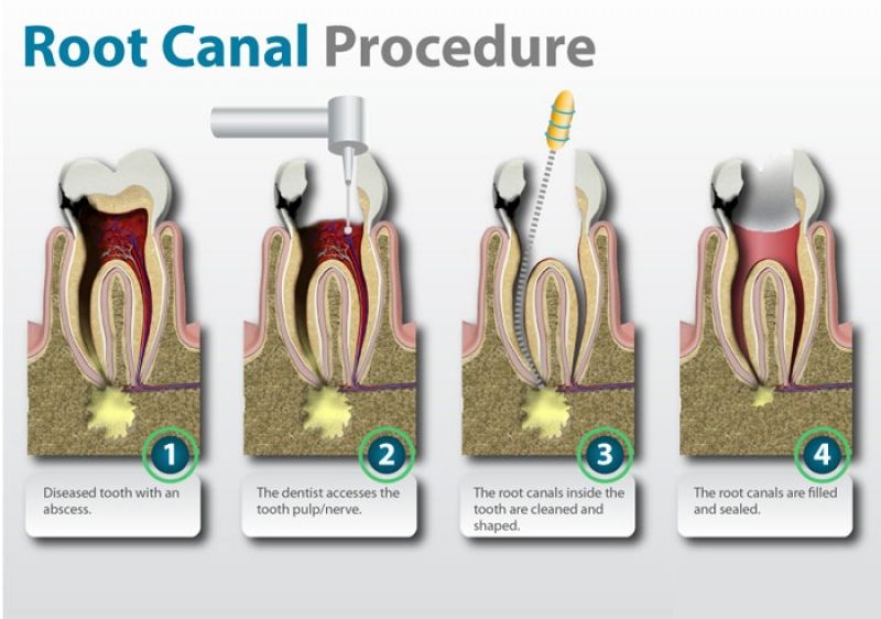 RCT Diagram, RCT pain relief, RCT recovery time, RCT cost south delhi