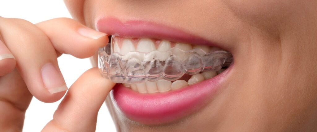 Invisible dental braces cost, dental braces cost in south delhi, dentist in lajpat nagar, dr priyanka khanna dental care 4u