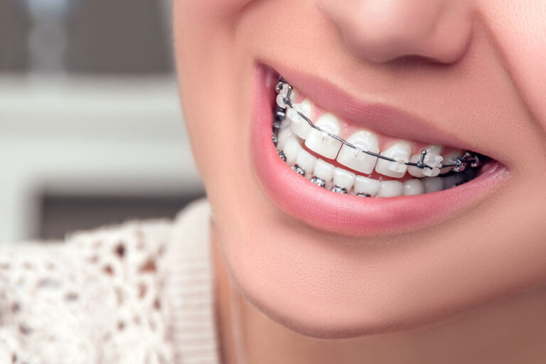 Read more about the article Dental Braces – Procedure, Fixing, Cost In Lajpat Nagar, South Delhi