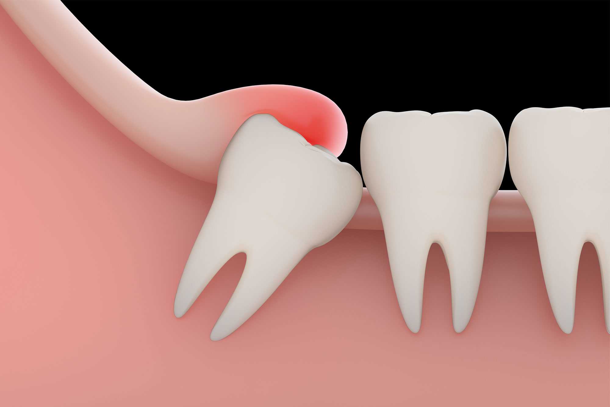 wisdom tooth extraction in lajpat nagar, painless wisdom tooth removal, dr priyanka khanna dental care 4u